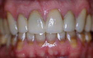 After Teeth Whitening Treatment