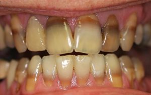 Before Teeth Whitening Treatment